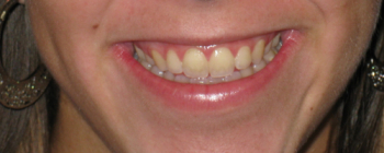 Creve Coeur & St. Louis Teeth Whitening, Artistic Dentistry