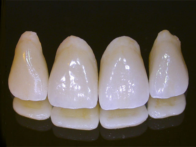 porcelain dental crowns