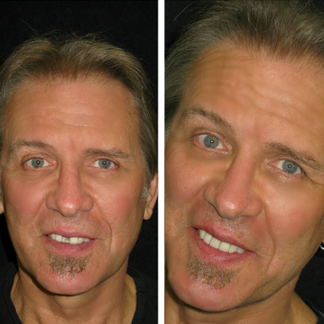 before and after photo of keith after receiving his implant and crown