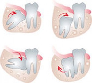 Wisdom Tooth Removal St. Louis, Creve Coeur, Artistic Dentistry